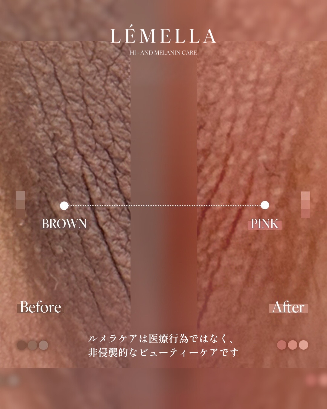 エステ23